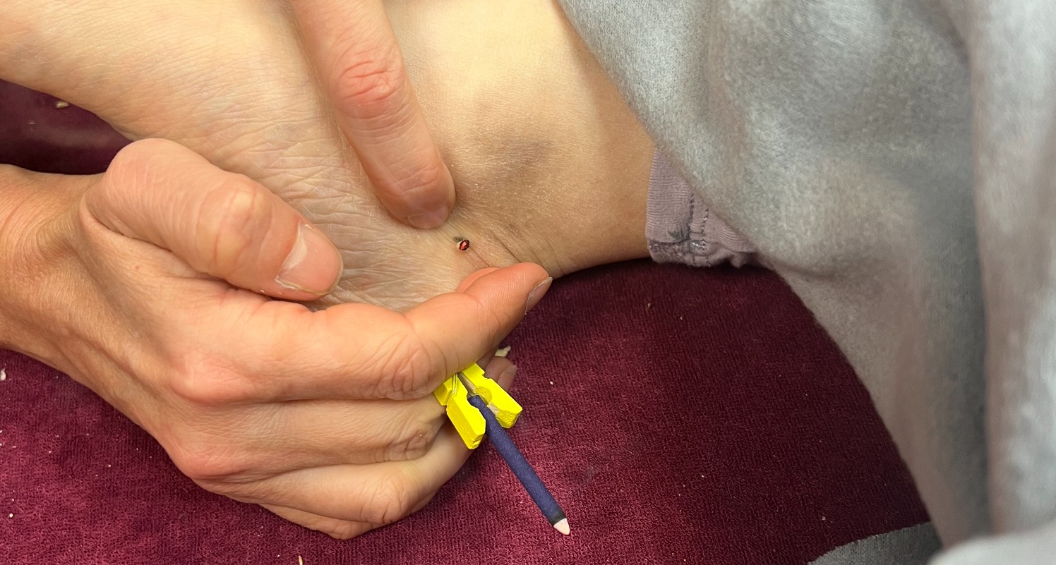 Moxibustion 43 Haute Loire