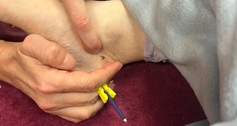 Moxibustion japonaise Ardèche